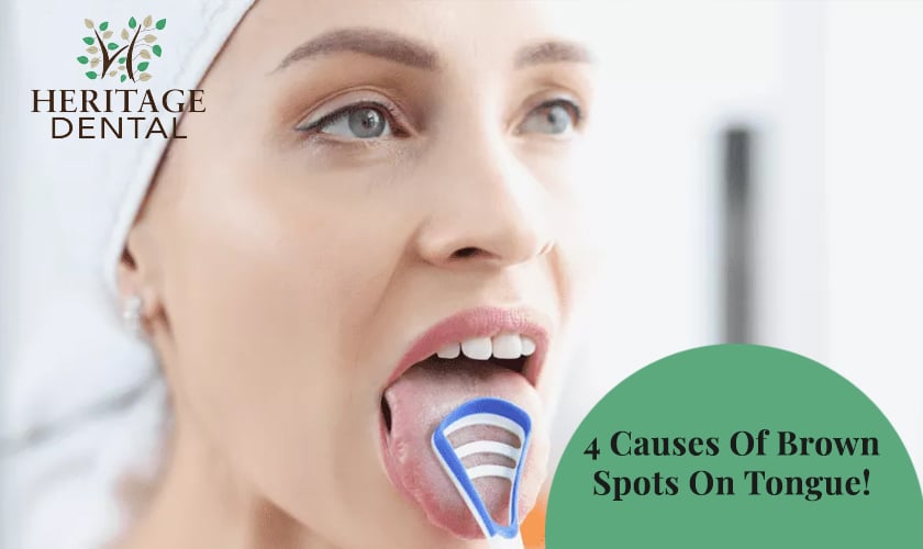 Brown Spots On Tongue