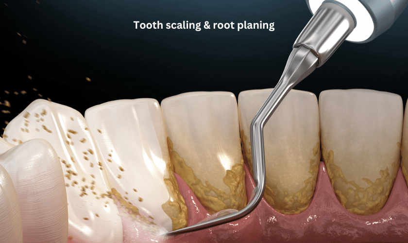 Tooth scaling & root planing