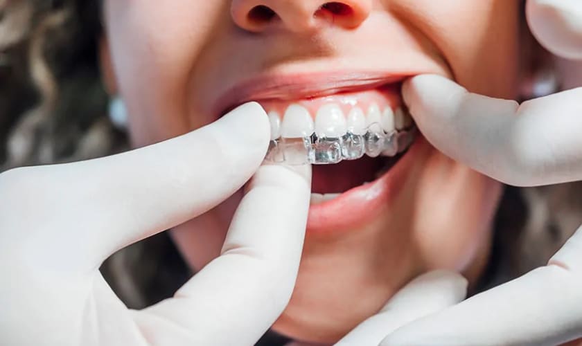 Clear Aligner Therapy - Heritage Dental – Katy