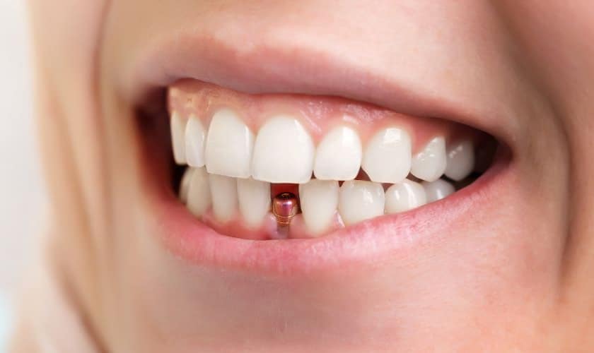 Dental Implants - Heritage Dental – Katy