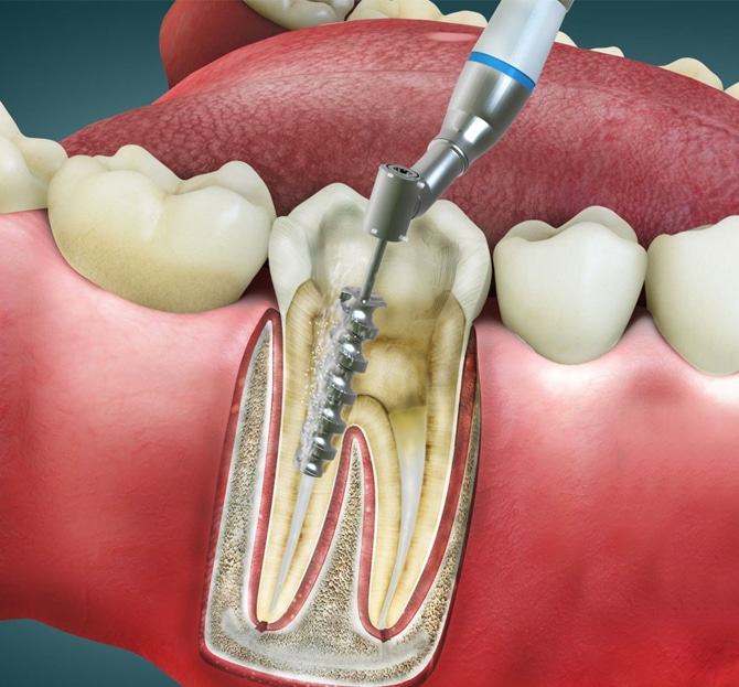 restorative dentistry in katy tx, heritage dental - katy