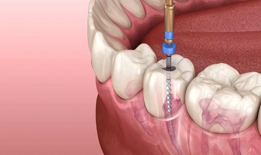 What to Do If a Root Canal Gets Infected