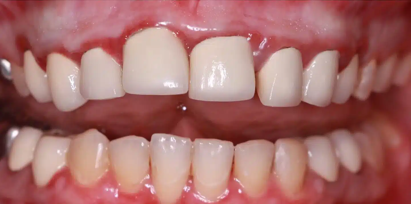 teeth whitening katy