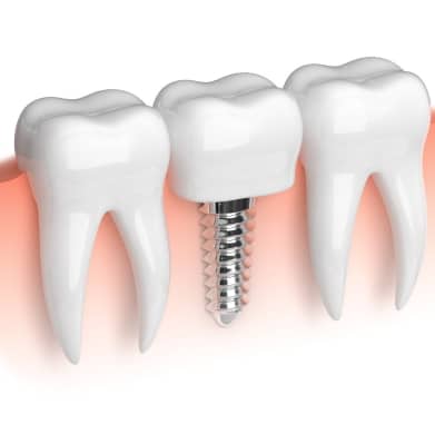how often you should visit your dentist after getting dental implants