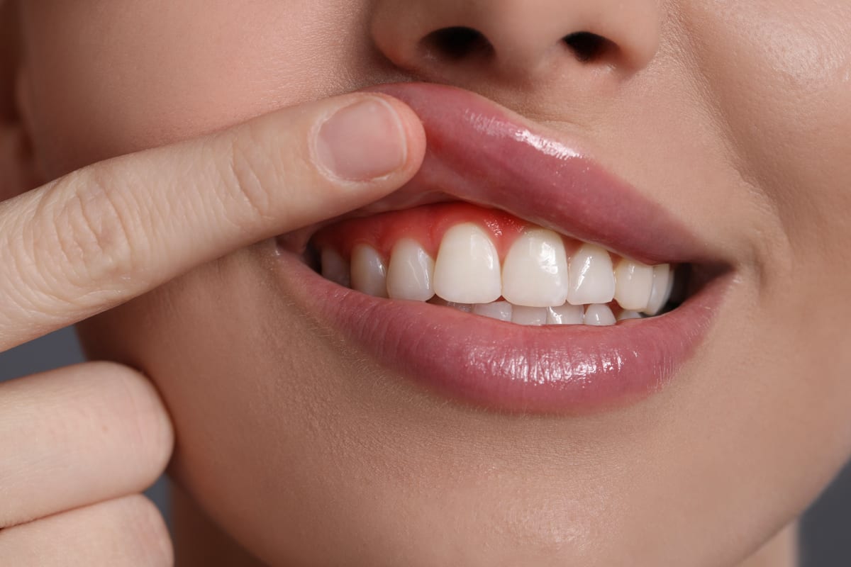 Gum Disease Treatment in Katy