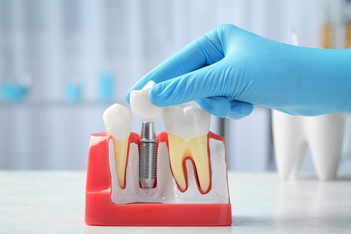 Dental Crowns in Katy